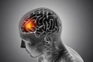 Aumentan accidentes cerebrovasculares